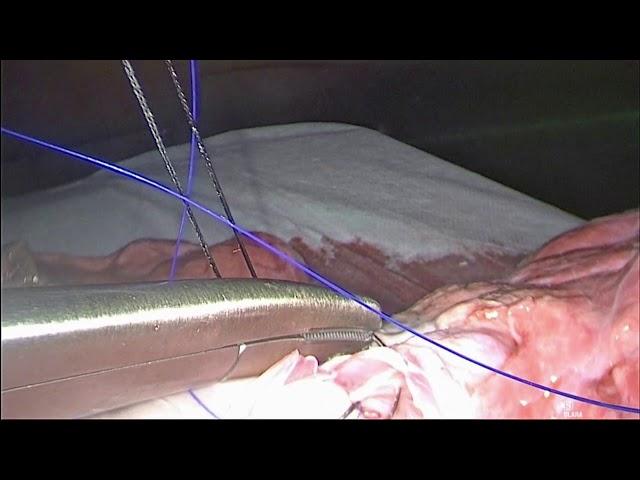 STS University 2019 - Course 12: VATS Sleeve Lobectomy