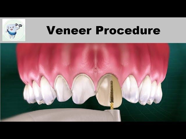 Dental Veneers Procedure Step by step