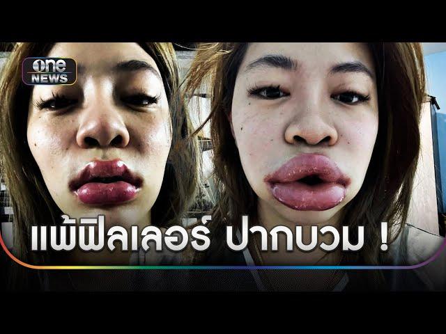 สาวแชร์อุทาหรณ์ แพ้ฟิลเลอร์อย่างหนักทำปากบวม  | ข่าวเที่ยงช่องวัน | สำนักข่าววันนิวส์