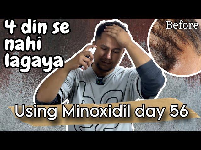 Day 56 Update  Left Minoxidil for 5 days  cause HAIRFALL #hairgrowthjourney #minoxidilsideeffects