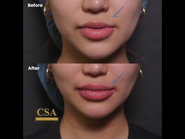 Correcting lip asymmetry And introducing Hollywood spectra for treatment of post acne inflammation