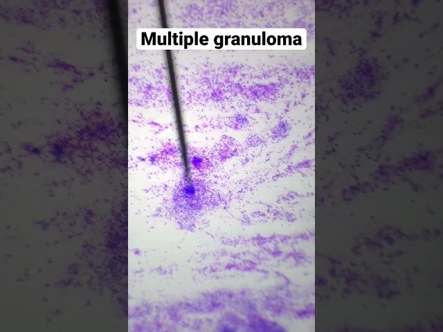 Multiple granuloma on cytology smear (10x view)#Cytology #Pathology