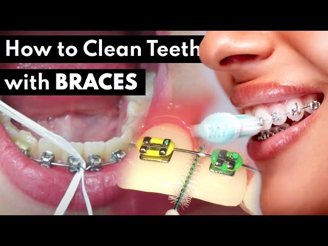 Braces Care Routine |  Water Flosser, Brushing, Rinsing etc.