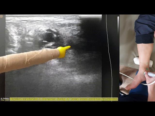 330.(의사용. Physical & US finding) Tarsal tunnel syndrome by Ganglion. 결절종에 의한 족근관 증후군[강찬.정형외과.Chan]