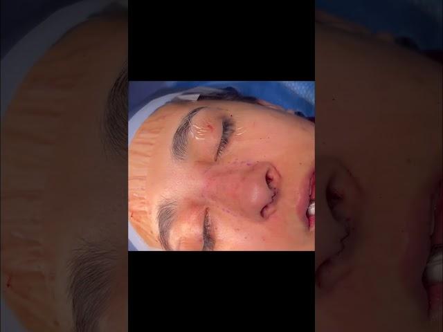 Rhinoplasty Before and After | Instant Rhinoplasty Reveal | Dr. Sarah Saxon #nosejob