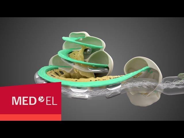 Cochlear Implant Electrodes to Stimulate Each Tone at the Right Place