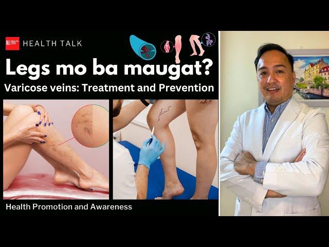 Legs mo ba maugat? Varicose veins: Treatment and Prevention