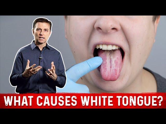 What Causes White Tongue? – Dr.Berg on Oral Candidiasis