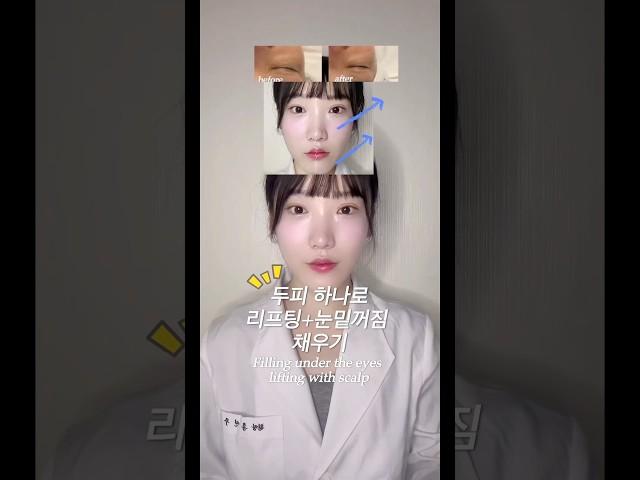 두피로 눈밑꺼짐+리프팅+옆광대 없애기