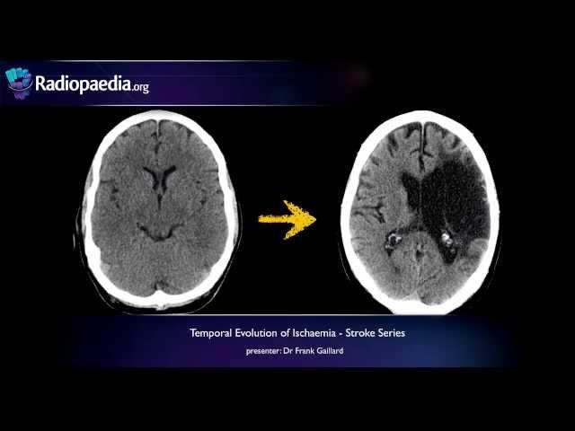 Stroke: Evolution from acute to chronic infarction - radiology video tutorial (CT, MRI)