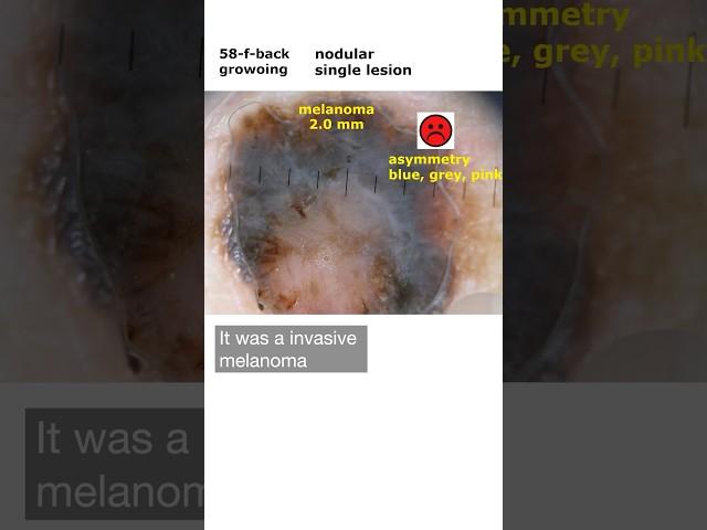 Fit for Dermoscopy: Management decision of malignant and benign skin lesions