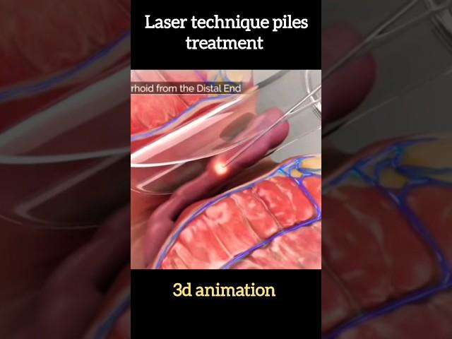 piles treatment with laser technique #shorts #short #treatment #humanbody #medical #3danimation