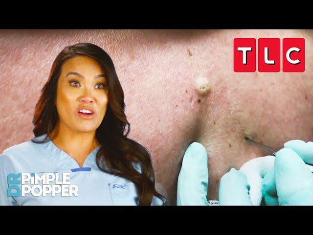 The BEST Blackhead Pops | Dr. Pimple Popper | TLC