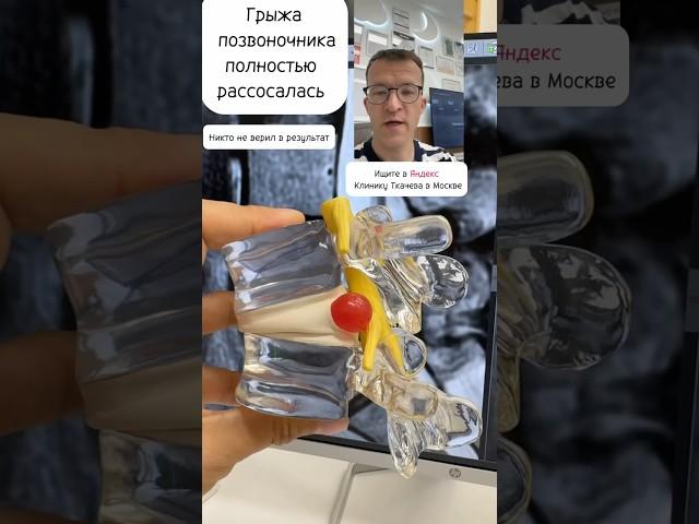 Грыжа позвоночника рассосалась, хотя никто не верил в успехи