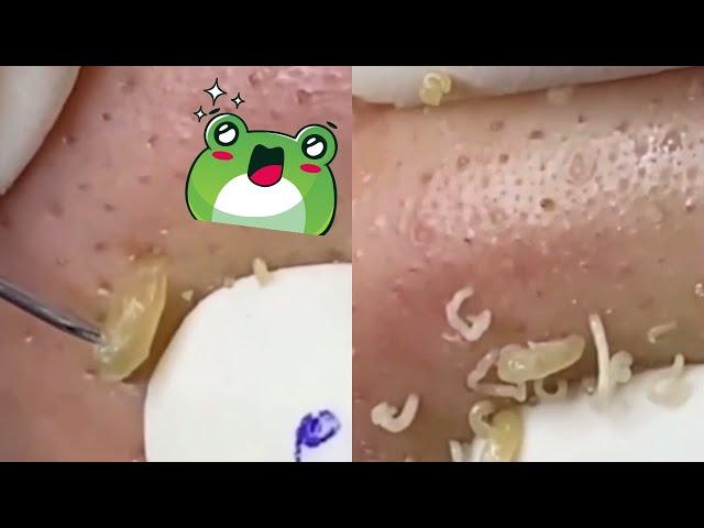 Ultimate Blackhead Extraction: Satisfying Pimple Popping