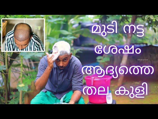 First Head Wash After hair transplantation | എന്റെ തല കുളി | safvan pullara |