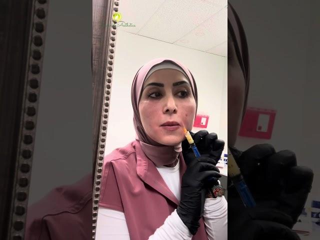 EZ Gel treatment (Plasma filler)