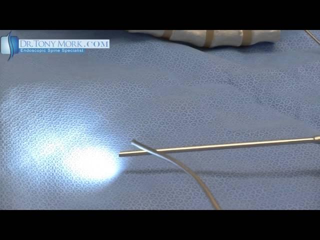 The Endoscope for Laser Spine Surgery