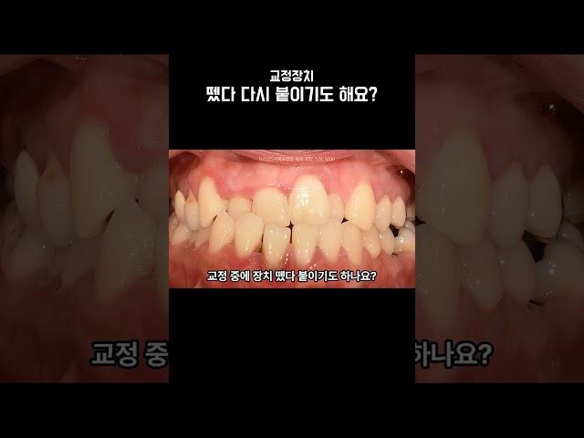 교정 중, 일부러 장치 뗐다 다시 붙이기도 해요?  #교정중생기는