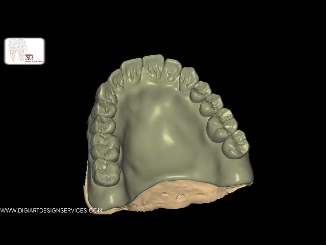 Creating the Perfect Denture Monoblock Design