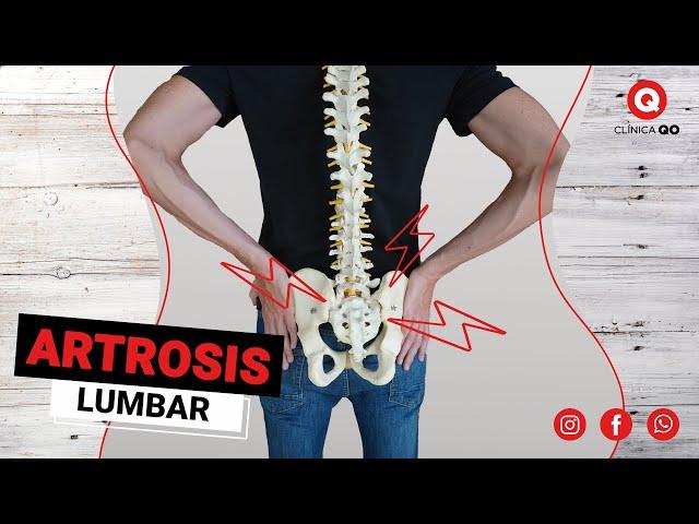 Cómo Aliviar la Artrosis Lumbar L4-5 y L5-S1 (50 años +)