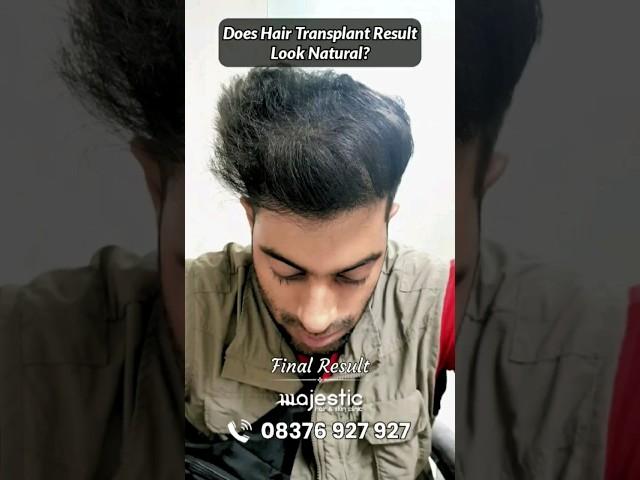 Best Hair Transplant Results in 12 Months #hairtransplantresults #hairtransplant #hairloss