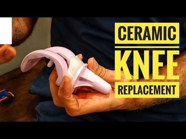 Life of Knee Replacement Implant