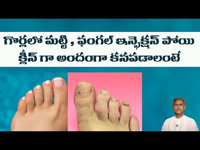 DIY Remedy to Get Beautiful Nails | Reduces Fungal Infections | Soft Nails |Dr.Manthena's Beauty Tip