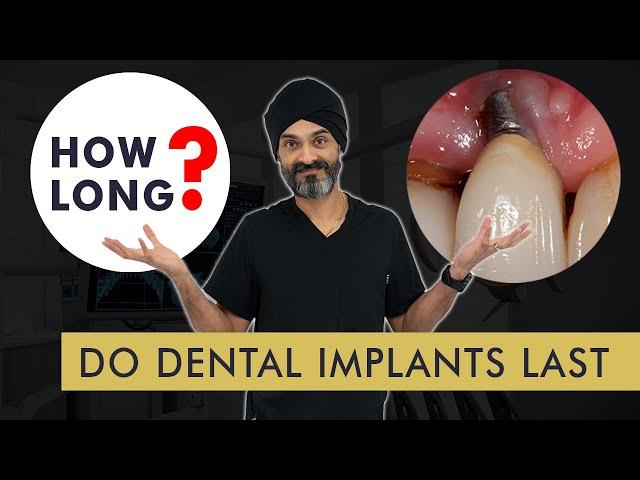 How Long Do Dental Implants Last?