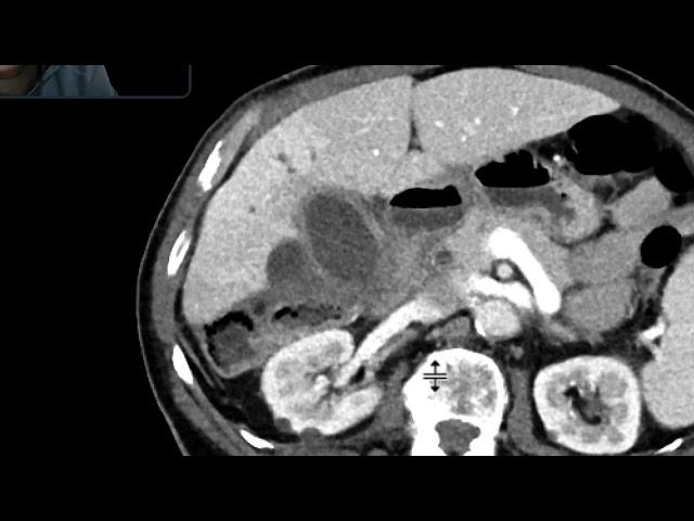 Perforated cholecystitis