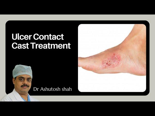 All About Total Contact Cast Treatment, Benefit, and Procedure at Surat Diabetic Foot Care Clinic