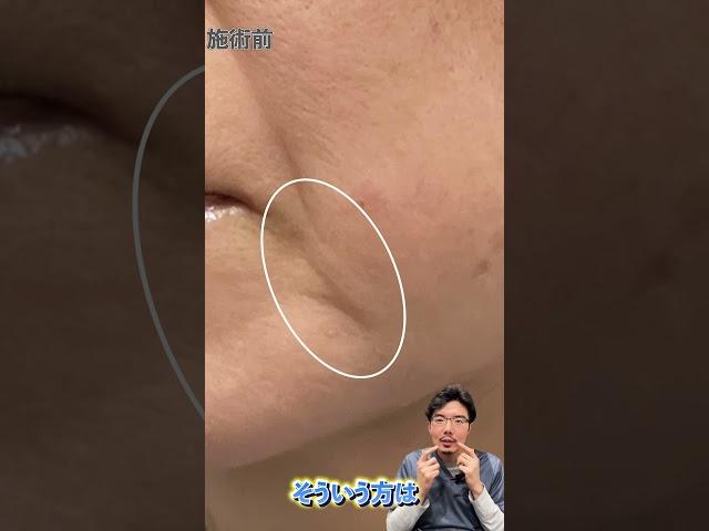 【Dr.菅原症例解説!!】マリオネットラインヒアルロン酸注入解説!!#junclinic #菅原順 ＃ヒアルロン酸