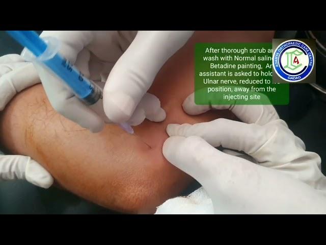 Golfer's Elbow | Epicondylalgia medial | Medial Epicondylalgia, local Steroid shot | Adamya Hosp Vid