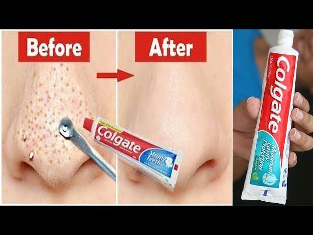 In Just 5 Mints Best Way to Remove BLACKHEADS With Toothpaste