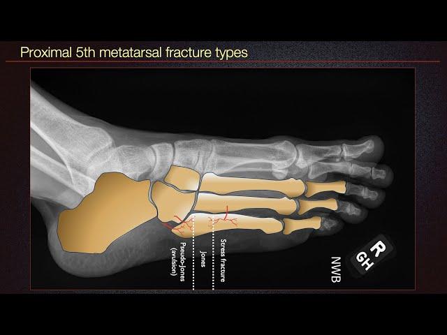 Case 20 Metatarsal fracture