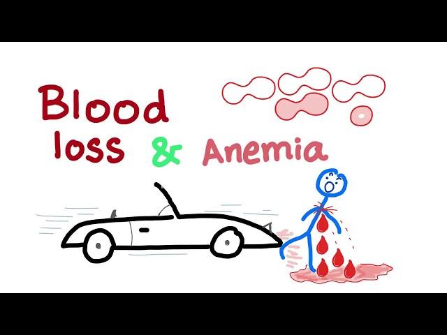 Blood Loss and Anemia - Hypovolemic shock - hemorrhagic shock - Causes of anemia