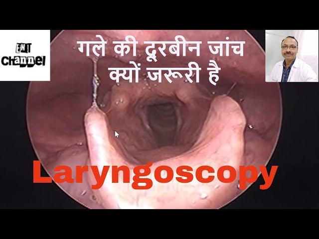 गले की दूरबीन जांच क्यो ज़रूरी है। What is fiber optic Laryngoscopy? Why endoscopy of throat ??