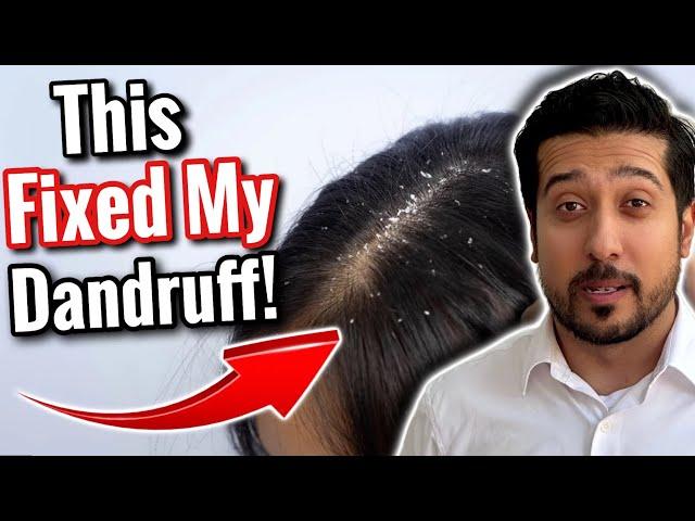 How to Get Rid of Dandruff For GOOD | This WILL Eliminate Dandruff