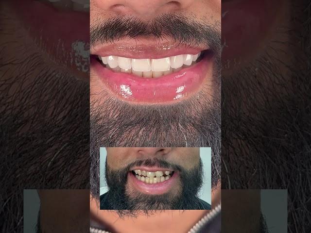 Fresh off the press with Dr. Josh  Invisalign, porcelain & composite #invisalign #veneers