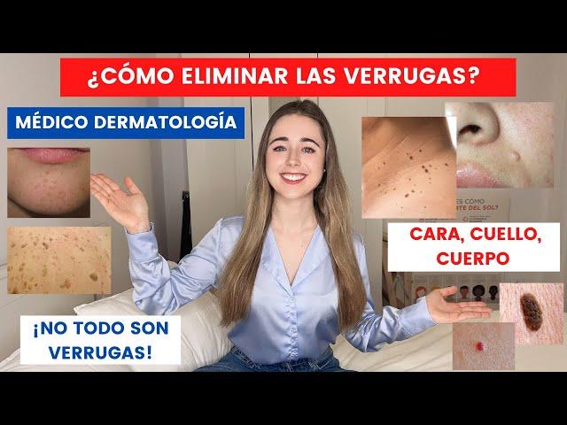 MÉDICO EXPLICA CÓMO ELIMINAR VERRUGAS EN CARA, CUELLO Y CUERPO: ¿EN CASA? | LO QUE NO SON VERRUGAS