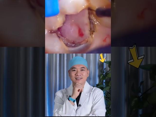 Hậu quả của sâu răng lâu năm I Nha Khoa Smile HT #shorts