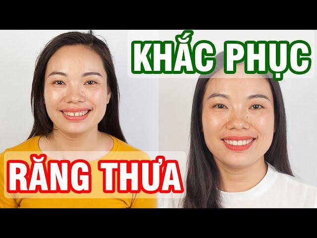 Mặt dán sứ veneer khắc phục khe thưa, siêu mỏng, nhỏ, bền, đẹp, hiệu quả  100%