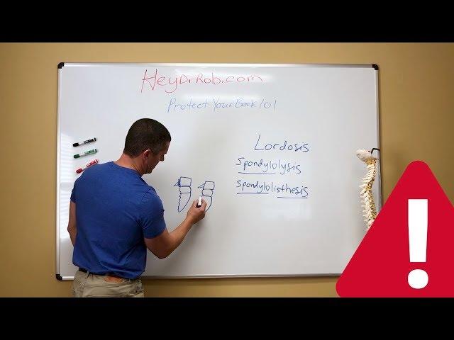 Chiropractor explains SPONDYLOLYSIS/SPONDYLOLISTHESIS and how to live with one!