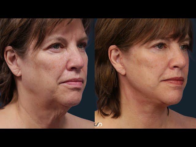 Traceless Face, Neck and Eyelid Lift | Before and After | Dr. David Stoker