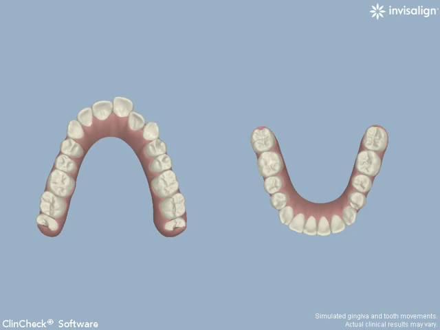 How do Invisalign Works - Cosmetic Dental Associates San Antonio,TX Dental Practice