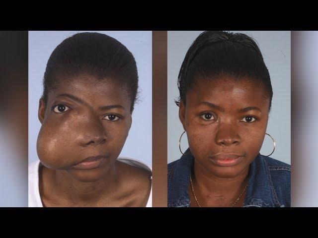 Maxillofacial Surgery: Changing Faces, Changing Lives - Kadiatu's Story