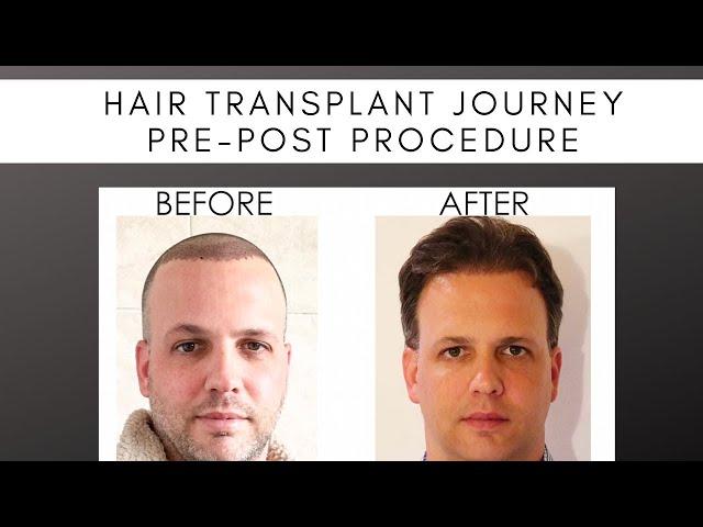 9-Month Hair Transplant INCREDIBLE Transformation