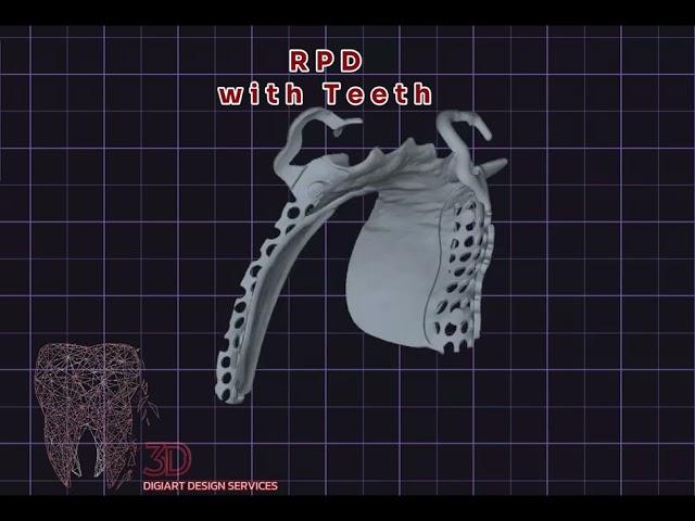 Removable Partial Denture with Teeth (RPD)