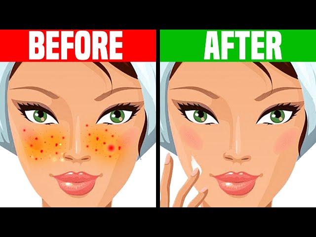 How to Get Rid of Acne OVERNIGHT