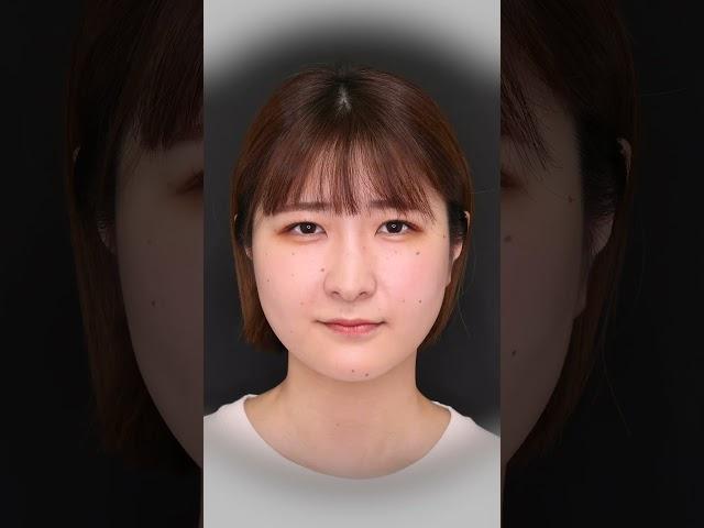 糸リフトで小顔に！